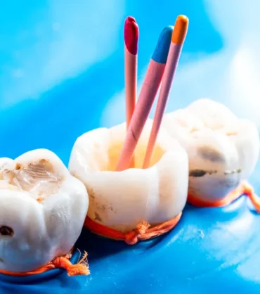 root canal treatment in dwarka