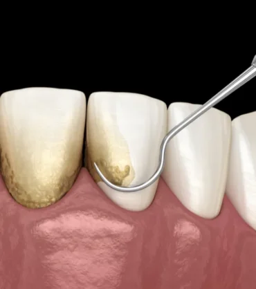 Scaling Treatment_11zon